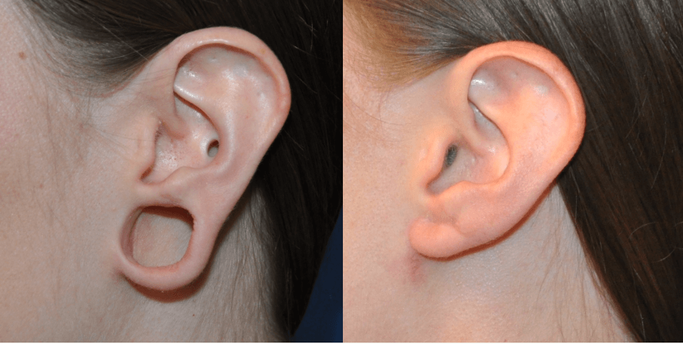 perfect earlobe repair in Varanasi
