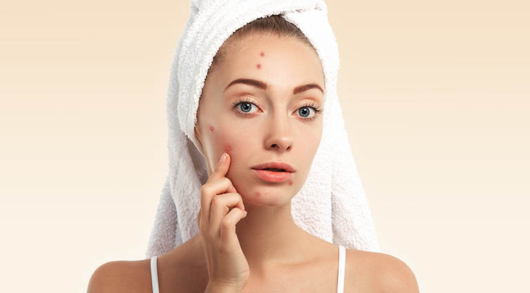 Acne: Types, Causes, Treatment & Prevention
