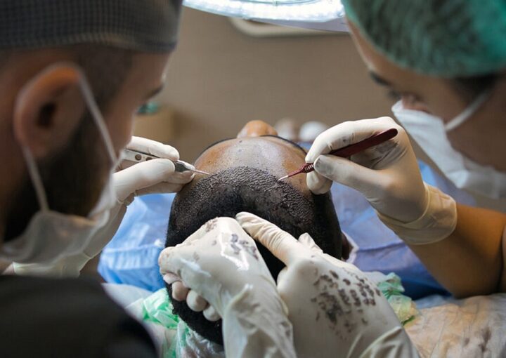hair transplant in Jaunpur