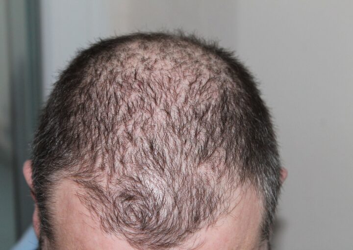 hair transplant jaunpur