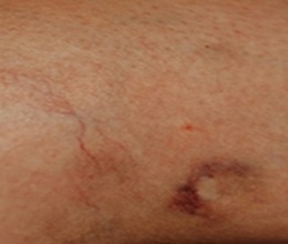 Morphea