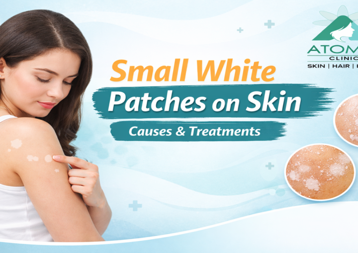 small white patches on skin - Atomic Clinic, Varanasi