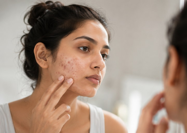 Adult Acne Treatment in Varanasi 1