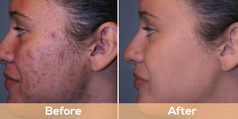 Acne Treatment