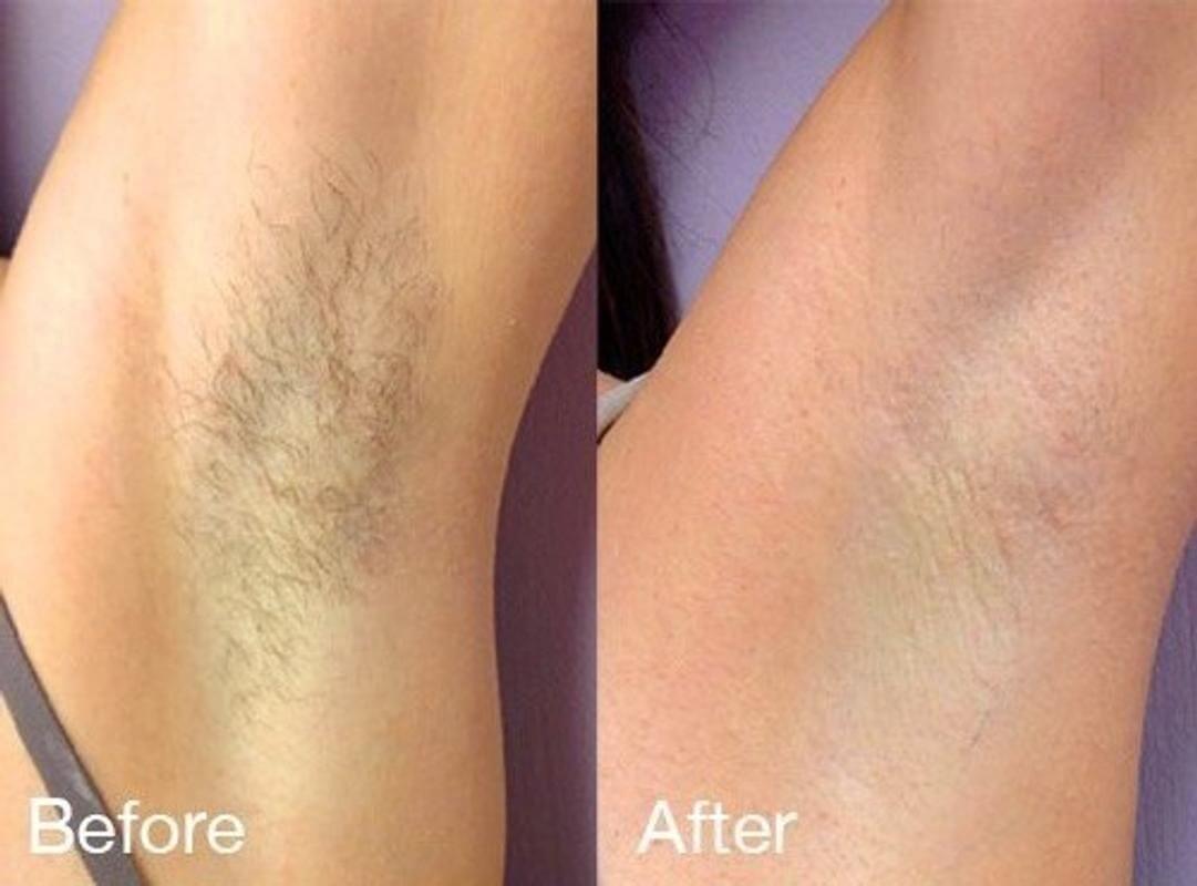 Laser Hair Removal