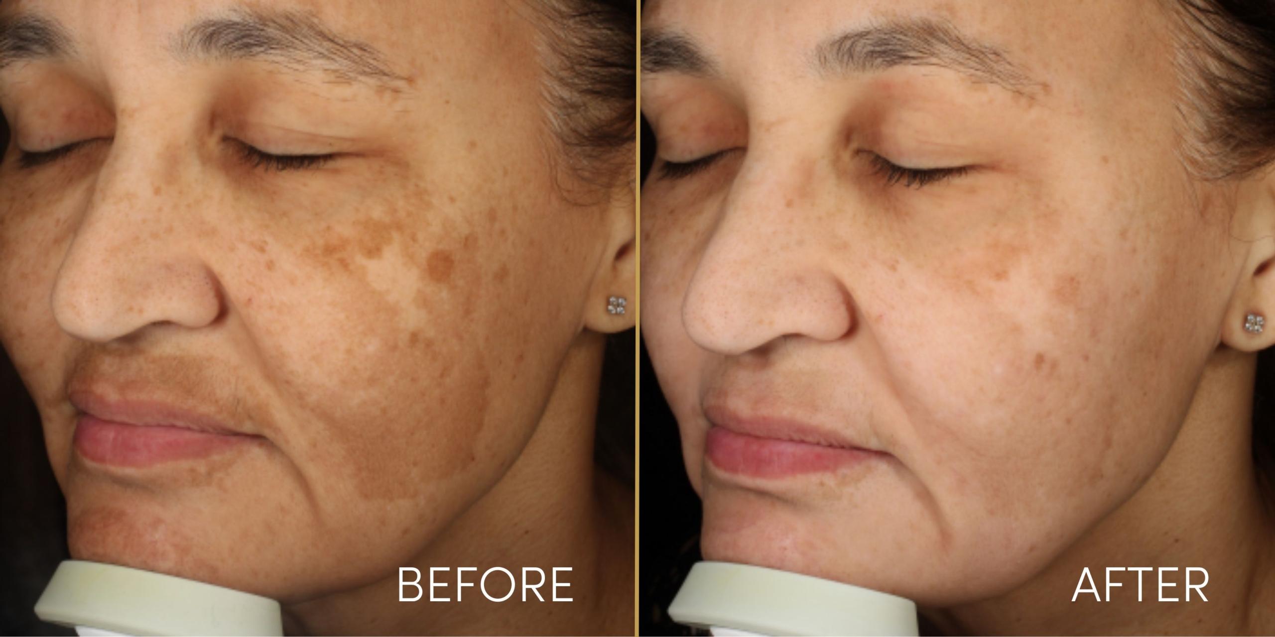 Melasma Removal