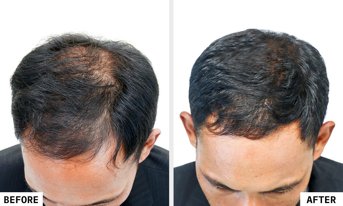 PRP Hair Therapy