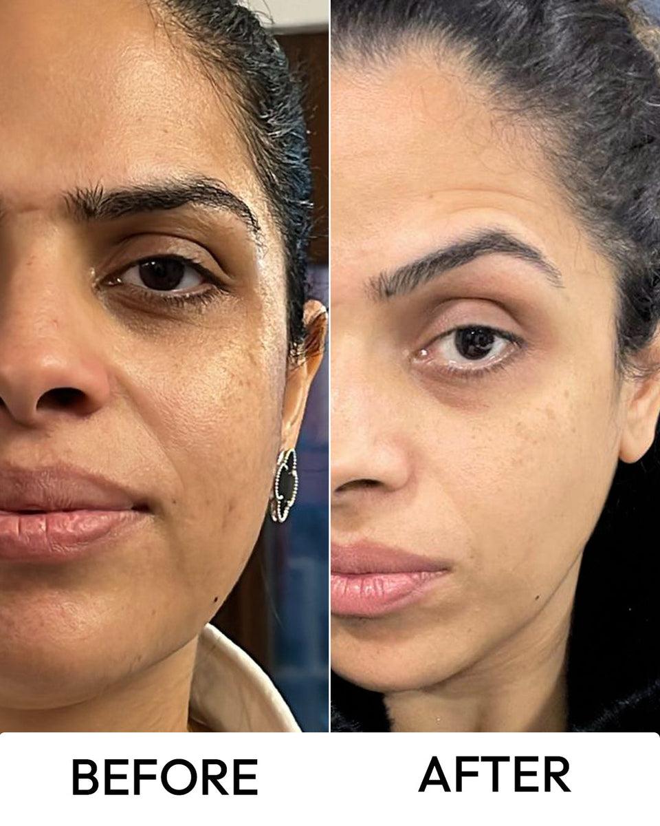 Skin Brightening