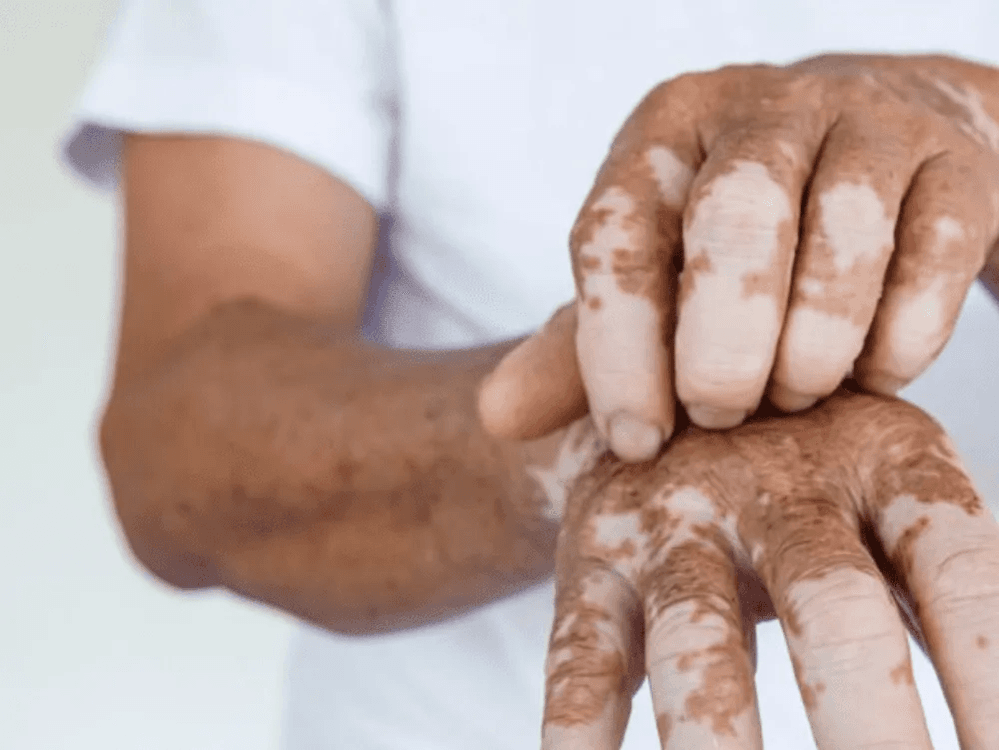 Vitiligo / Psoriasis